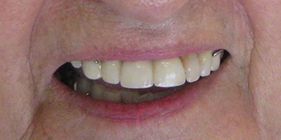 After-Teeth Six