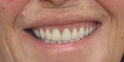 After-Teeth Five