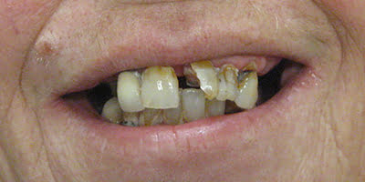 Before-Teeth Five