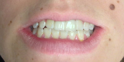 After-Teeth three