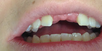 Before-Teeth three