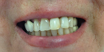 Before-teethone